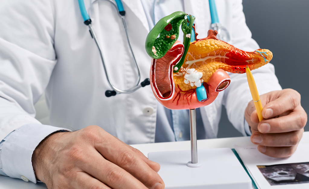 Metastatic Pancreatic Ductal Sdenocarcinoma (PDAC)